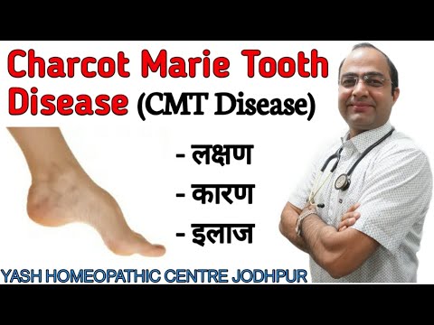 CMT ( Charcot Marie Tooth Disease ) HMSN disease | Cause Symptoms Best treatment