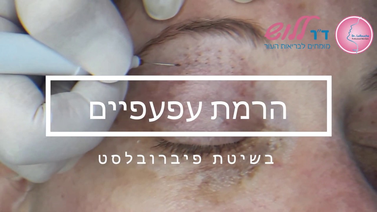 מתיחה והרמת עפעפיים – ללא ניתוח !