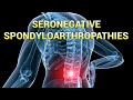 Seronegative Spondyloarthropathies (updated 2023) - CRASH! Medical Review Series