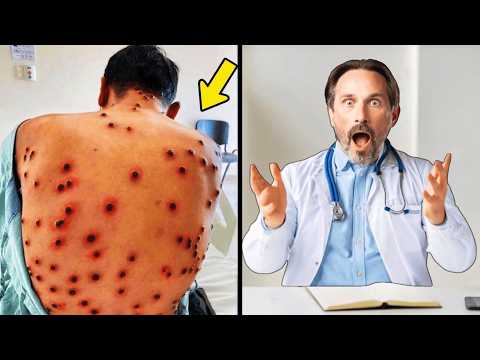 Pensa Di Avere 'Cimici Da Letto' - Gli Esperti Guardano Meglio E Impallidiscono