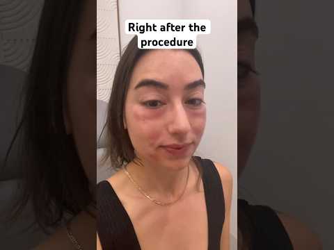 PRP injections for the first time #prp