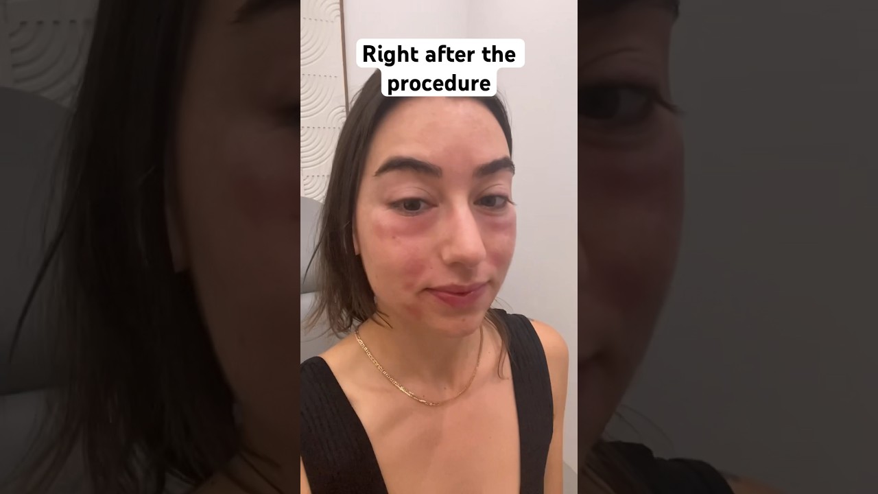 PRP injections for the first time #prp