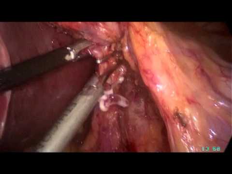 Thoracolaparoscopic Esophagectomy For Treatment Of Esophageal Cancer