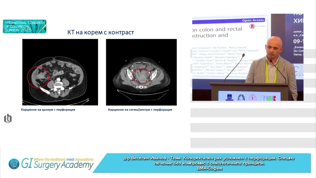 Colorectal Cancer Complicated by Perforation