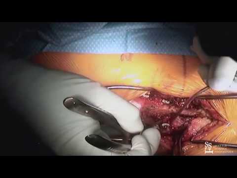 Lumbar Fusion - Live Surgery