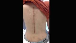 Staple's removal (from scoliosis surgery)