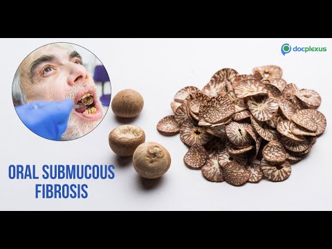 A Detailed Review of Oral Submucous Fibrosis
