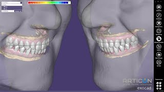 Functional total rehabilitation case + Face scan Exocad(Matera 2.3)