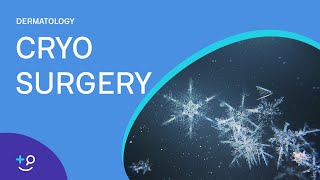 Cryo Surgery Procedure [Dermatology]