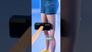 Doctor reacts: broken foot dance