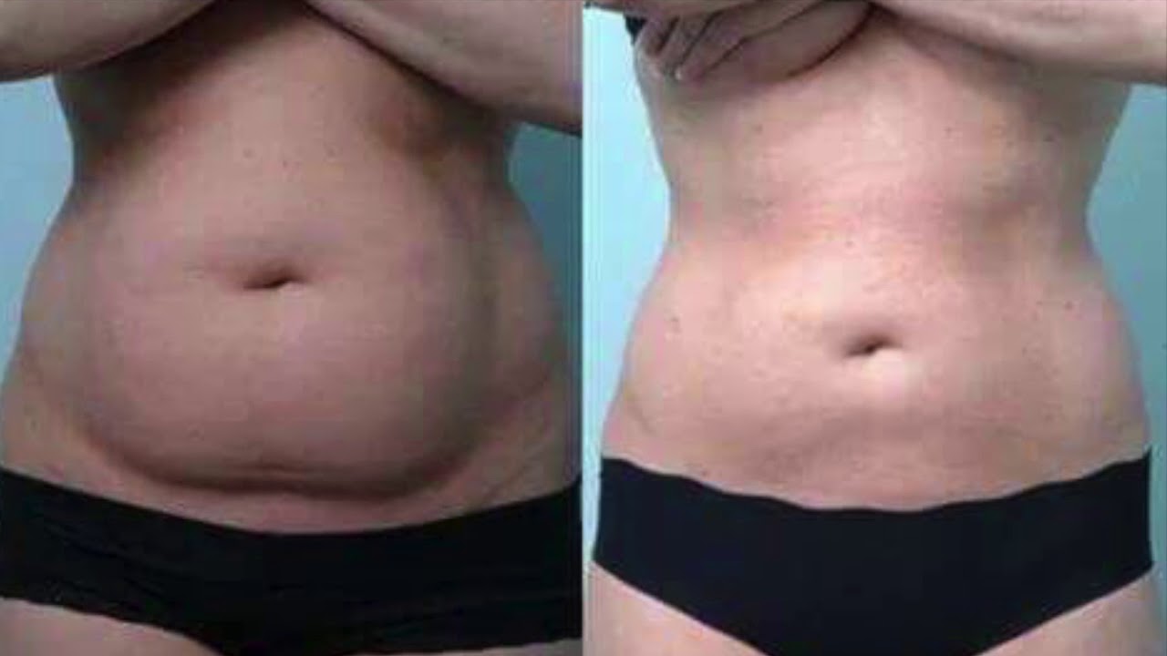 T-Shape Presentazione Prima e Dopo un mese