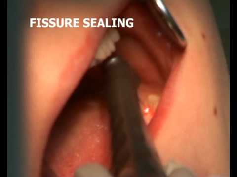 Fissure Sealing with Dental Laser