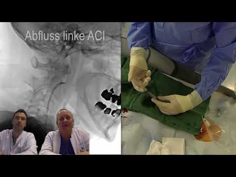 Tutorial einer DSA - Digitalen Subtraktionsangiographie bei Aneurysmablutung
