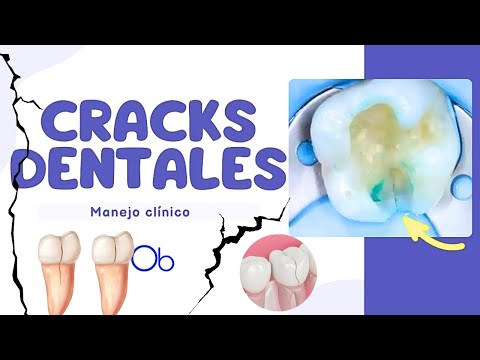 Cracks Dentales 🦷 ¿Cómo manejarlos?