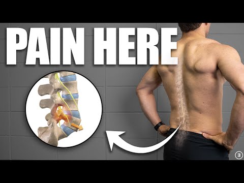 Lumbar Spondylolisthesis Rehab (Education | Exercises | Surgery | Myths)