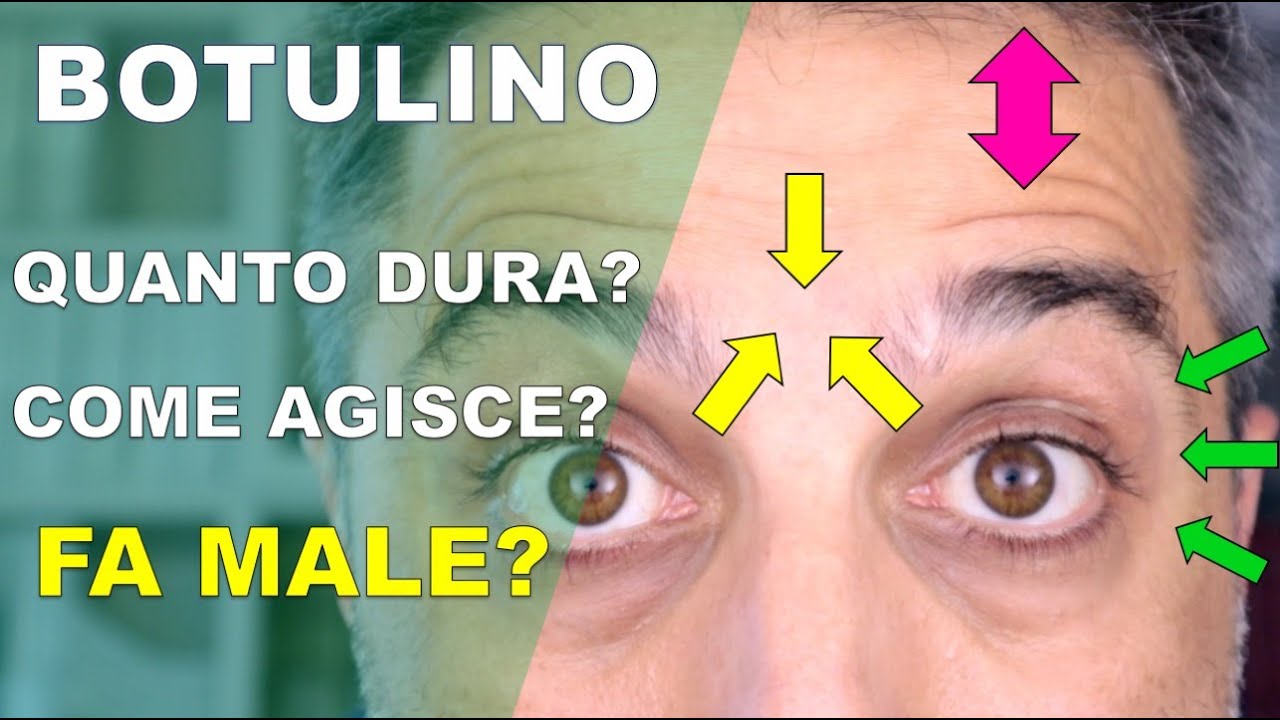 Watch Now Il BOTULINO spiegato in modo semplice Il BOTULINO spiegato in modo semplice