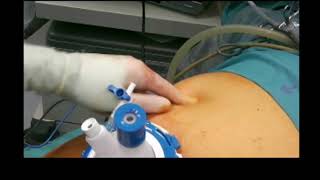 TPEA Lifter - Single-Port Laparoscopic Cholecystectomy