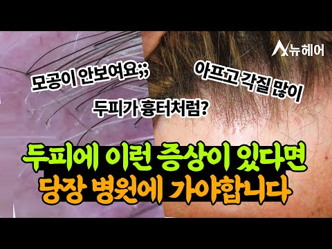 두피가 흉터처럼..? 당장 치료해야 합니다!ㅣ전두섬유성탈모ㅣ뉴헤어