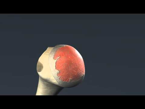 Einbau einer Schulterprothese