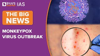 Monkeypox Viral Disease Spreading Rapidly In Europe & North America - Symptoms & Risk