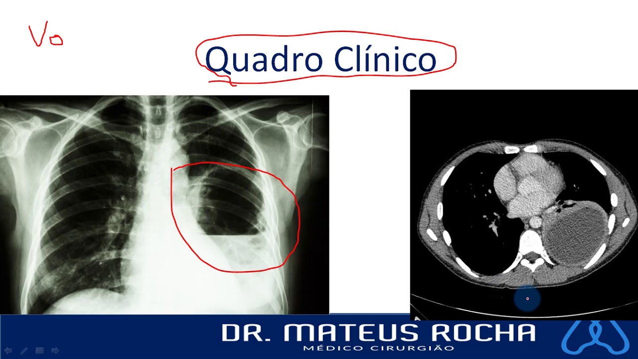 Abscesso Pulmonar // Pneumonia Necrotizante