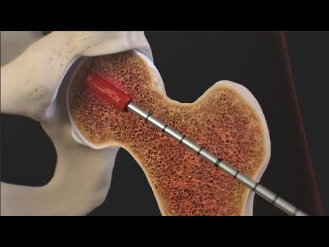 IntraOsseous BioPlasty® (IOBP) Surgical Technique for a Bone Marrow Lesion of the Hip
