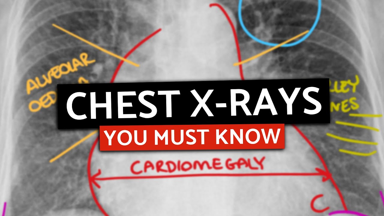 10 MUST KNOW Chest X-Rays For Medical/PA Finals | CXRs Made Easy