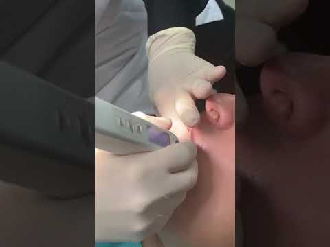 Dentist making painless local anesthesia injection.