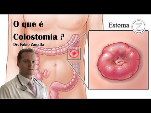 súlycsökkenés az ileostomia megfordítása után