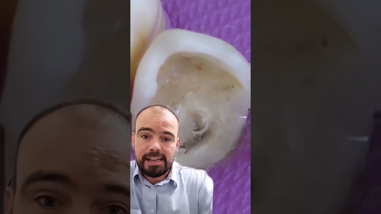 Dente cariado com canal e  coroa com pino #jeandentista #dentistas #proteses #tratamentodecanal