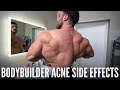 DEALING WITH ACNE AS A BODYBUILDER SIDE-EFFECTS…