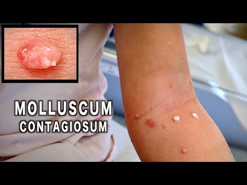 molluscum contagiosum sau condilom