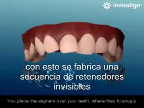 Que es la ortodoncia sin Brackets?