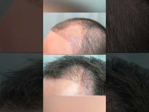 Factors that Limit Hair Transplant Density #hairtransplant