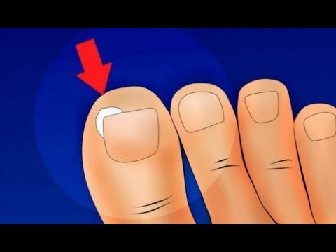Die Salbe für die Behandlung des Geschwürs unter dem Nagel Die Apotheke farmakopejka lozeril
