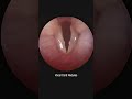 Pediatric Vocal Cord Nodules Development and Resolution Time Lapse