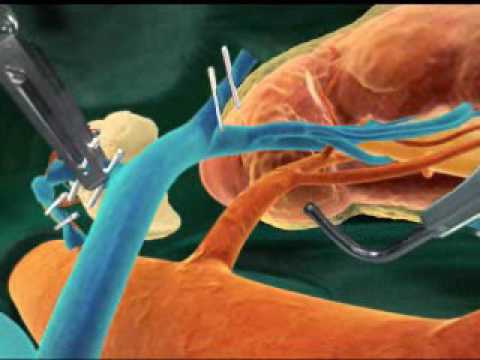 download lagu mp3 mp4 Selena Gomez Kidney Transplant Age, download lagu Selena Gomez Kidney Transplant Age gratis, unduh video klip Selena Gomez Kidney Transplant Age