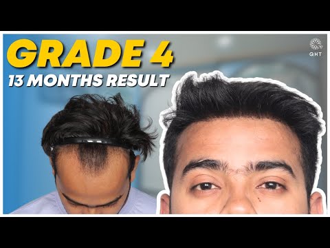 Hair Transplant in Chennai | Best Results & Cost of...