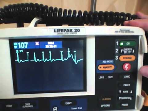 Cardioversion of Atrial Fibrillation