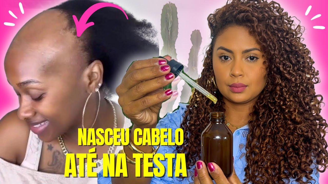 EU NÃO ESPERAVA! O CABELO DA MINHA CARECA ESTÁ CRESCENDO LOUCAMENTE! 100% DE EFICIÊNCIA! ✨