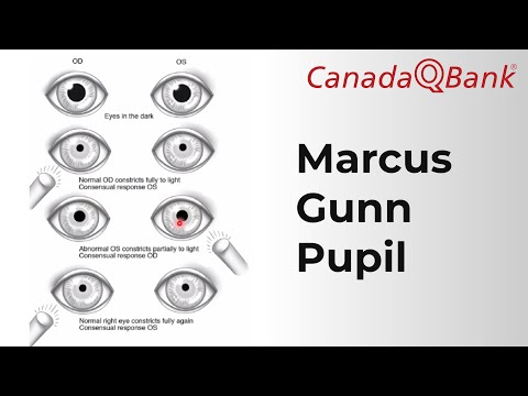 Marcus Gunn Pupil