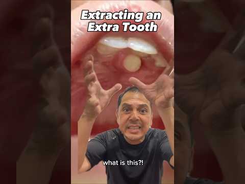 Pulling Out an EXTRA Tooth Explained (Supernumerary Hyperdontia) | View Mobile Dental #shorts