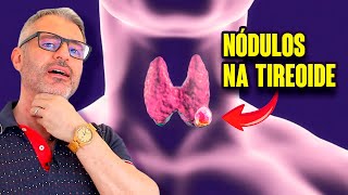 Nódulos na Tireoide: causas e tratamentos