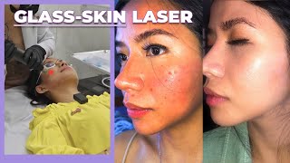 I Got Rid Of My Acne Scars, Dark Spots & Fine Lines with Picosure Laser | #glassskin #acnescars