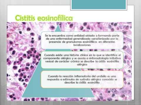 prostatita umflarea picioarelor