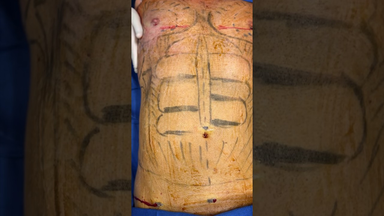 Awake Lipo and gyno excision!