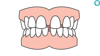 How To Close Gaps Between Teeth (Without Braces)