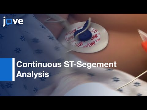 Continuous ST-Segement to detect Myocardial Ischemia | Protocol Preview