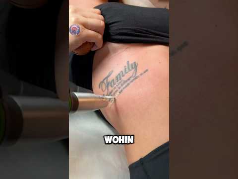 Wohin verschwindet die Tinte von entfernten Tätowierungen?