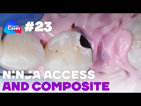 Ninja Access And Composite